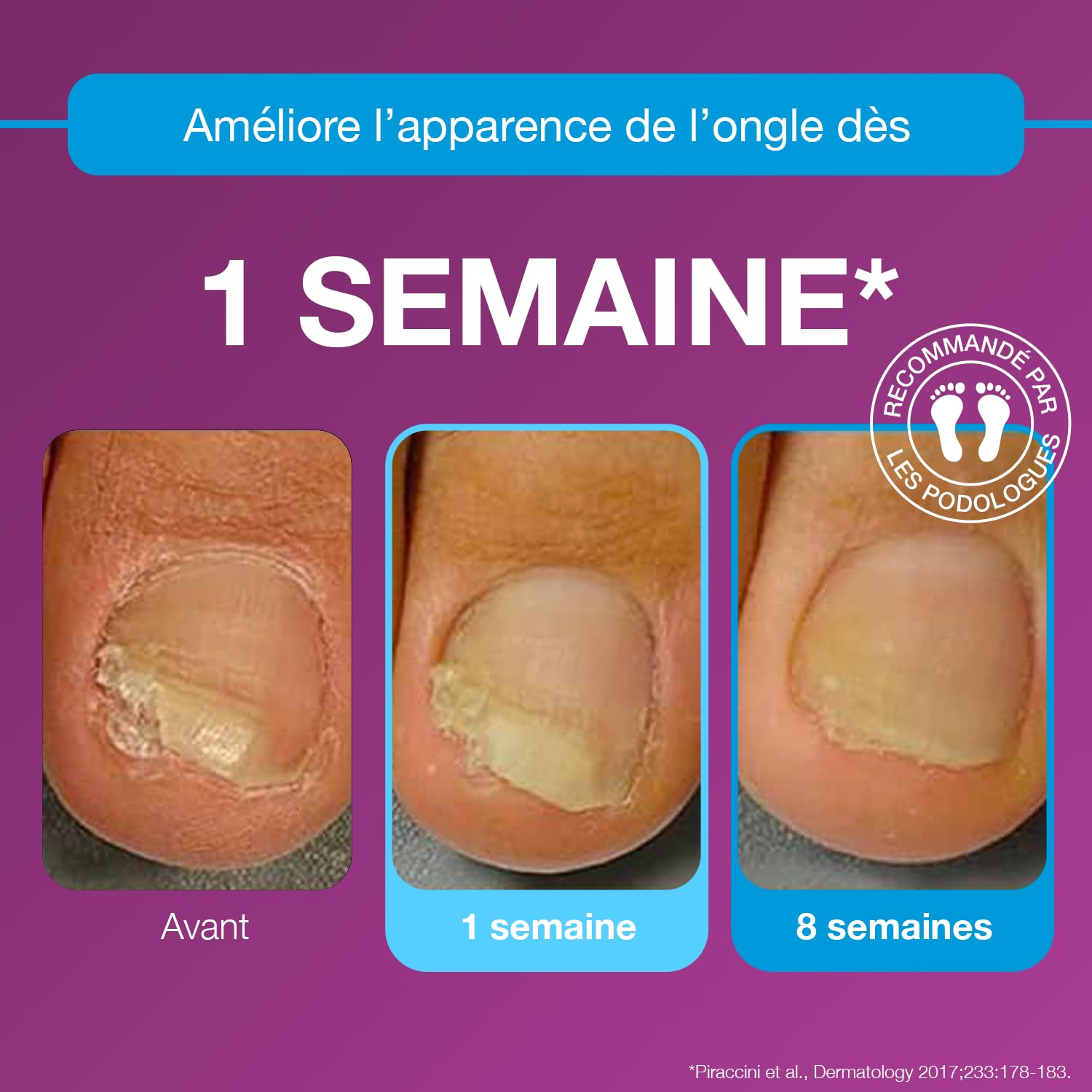 emtrix-ongle-traitement-mycose-ongle-pied-10-ml-sans-limage image 3