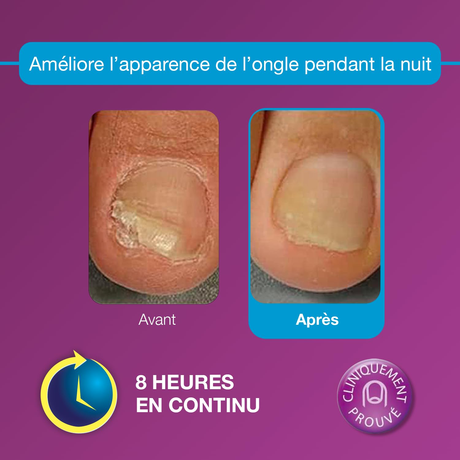 emtrix-ongle-patch-nuit-mycose-pied-14-patchs-ur-e image 3